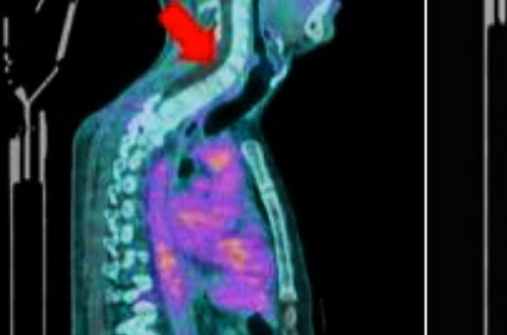 PET-CT imaging of injured spinal cord a participant with various degrees of neurological severity and function